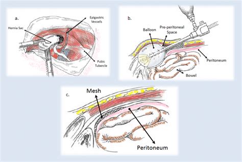 Laparoscopic Inguinal Hernia Repair - Surgical Procedure 1st Edition Epub