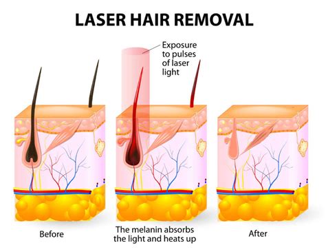 Laser Hair Removal Course: 5 Reasons You Need to Take It Now