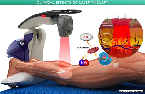 Laser Therapy: