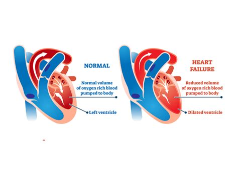 Left Sided Heart Failure: 7 Signs You're at Risk