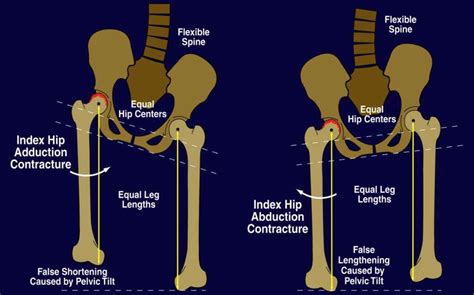 Leg Length Discrepancy: