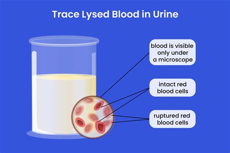 Leu Trace in Urine: A Comprehensive Guide