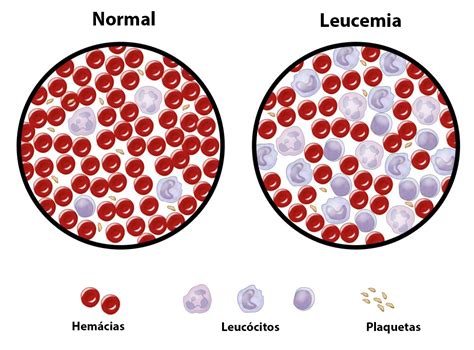 Leucemias