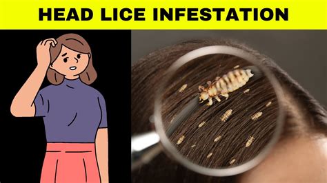 Lice Infestation: A Widespread and Treatable Problem