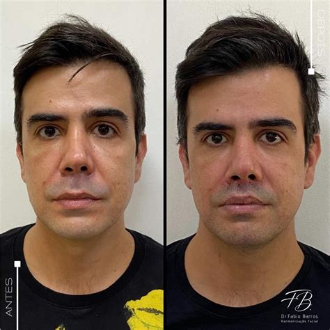 Lip Lift Antes e Depois: Um Guia Completo