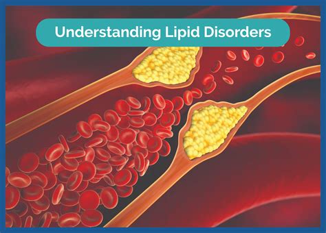 Lipids and Lipid Disorders Kindle Editon