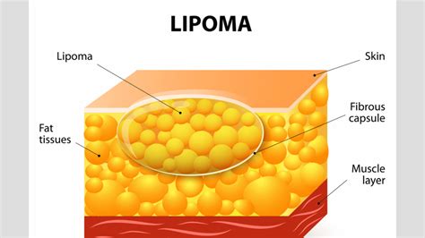 Lipoma Treatment in Homeopathy: Exploring Nature's Healing Power