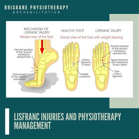 Lisfranc Injuries: A Comprehensive Guide