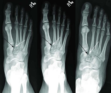 Lisfranc injury