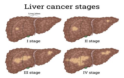 Liver Tumor Size Chart