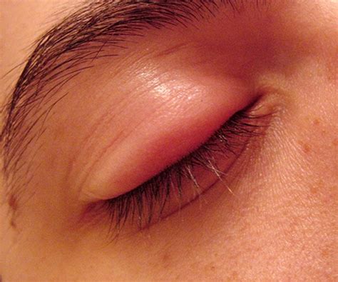 Lower Eyelid Swollen and Sore: Everything You Need to Know