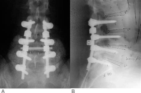 Lumbar Fusion and Stabilization Reader