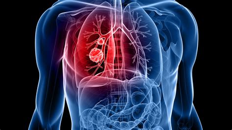 Lung Cancer PDF