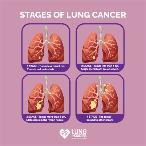 Lung Cancer: