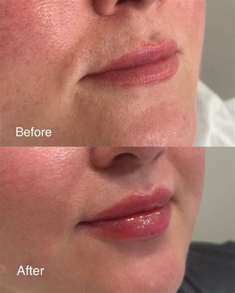 Luscious Lips: A Comprehensive Guide to Lolly Lips Enhancement