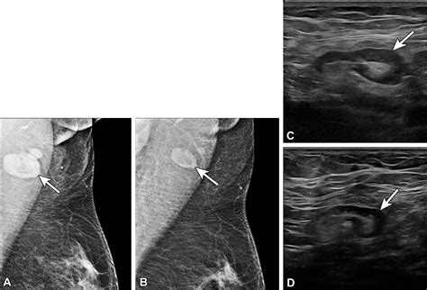 Lymphadenopathy: