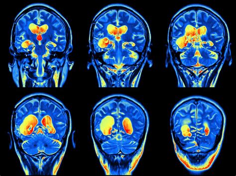 MRI Brain with Contrast