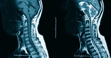 MRI With Contrast