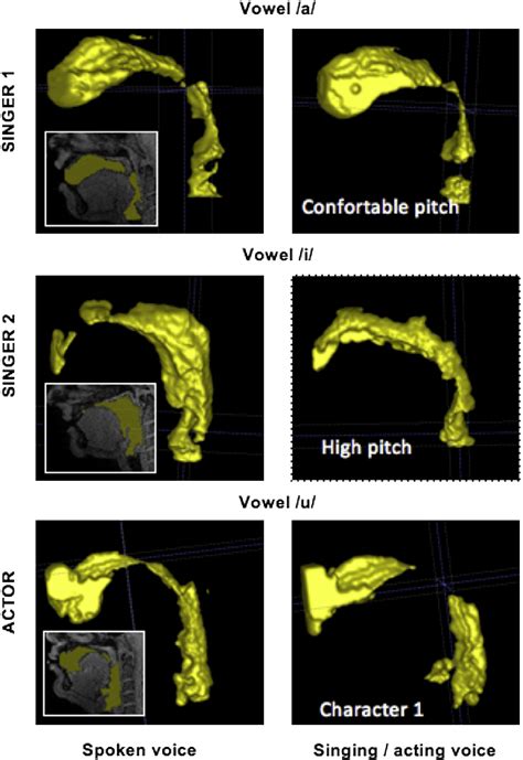 MRI-based vocal synthesis: