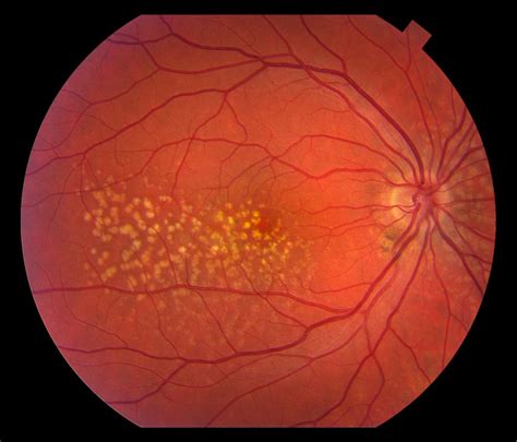 Macular degeneration: