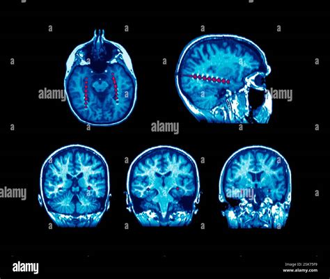 Magnetic Resonance in Epilepsy Doc