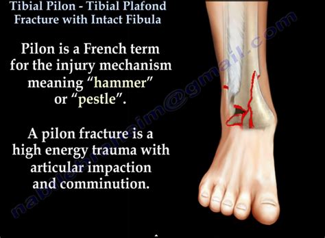 Major Fractures of the Pilon Doc