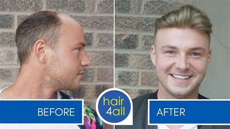 Male Hair System: The Ultimate Guide to Non-Surgical Hair Replacement