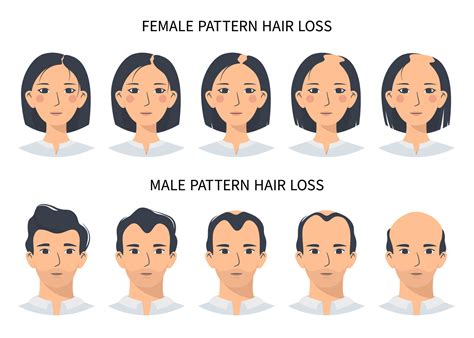 Male Pattern Baldness (Androgenetic Alopecia):