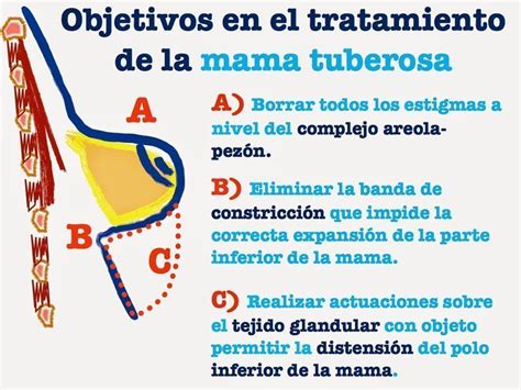 Mamas Tuberosas: o que é, causas, sintomas, tratamento e prevenção