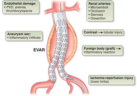 Management of Complications After Evar and Tevar Doc