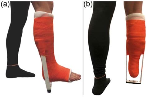 Mastering the Healing Powers of the Patella Tendon Bearing Cast