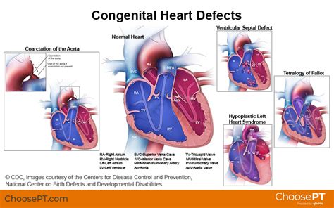 Mavi Baby: A Comprehensive Guide to Congenital Heart Defects in Newborns