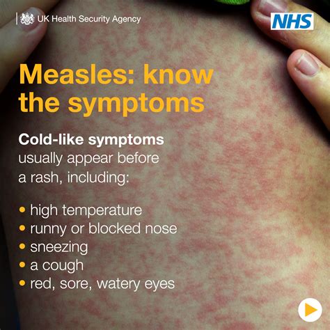 Measles: