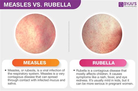 Measles and Rubella Epub