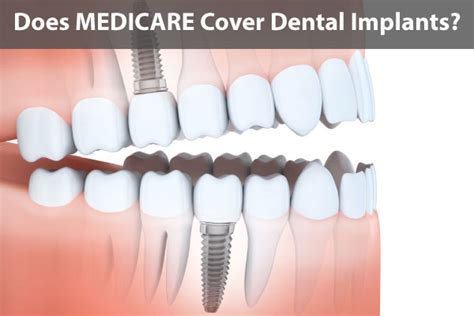 Medicare and Dental Implants: The Complete Guide for Seniors