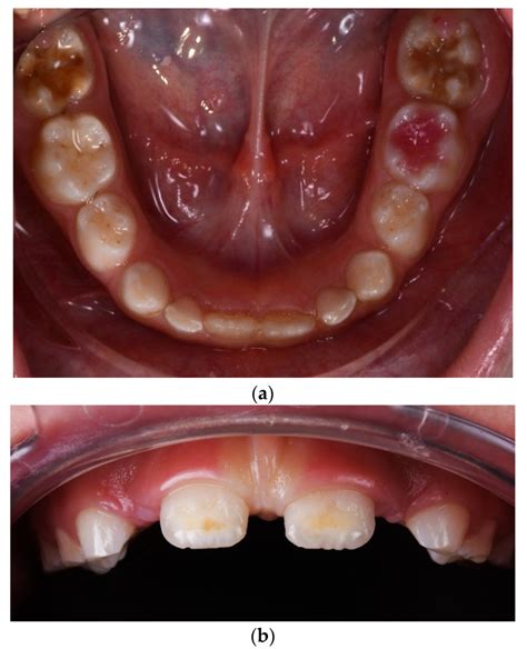 Mellie D.: A Comprehensive Guide to Understanding Molar-Incisor Hypomineralization