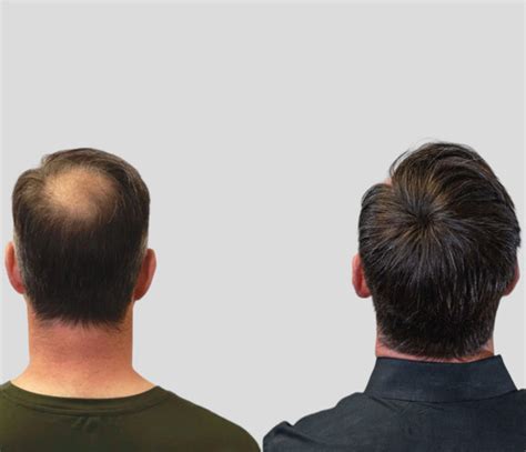 Men's Hair Pieces: A Comprehensive Guide to Regaining Your Crowning Glory