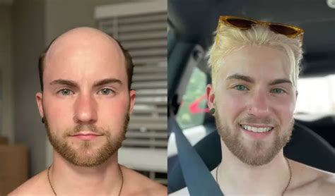 Men's Hair Systems: 7 Transformation Stories