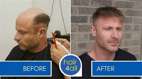 Men's Hair Systems: The Ultimate Guide to Non-Surgical Hair Restoration