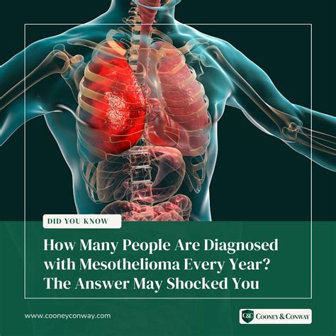 Mesothelioma: The Silent and Deadly Cancer