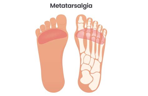 Metatarsalgia: