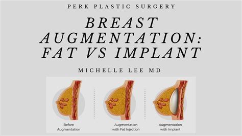 MiaBigTits: Exploring a New Frontier in Breast Augmentation Surgery