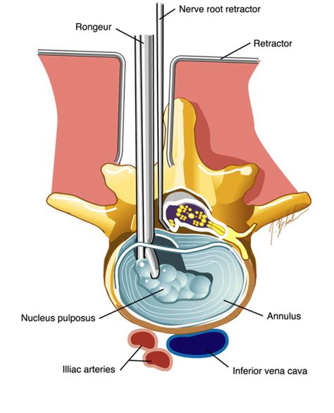 Microdiscectomy: