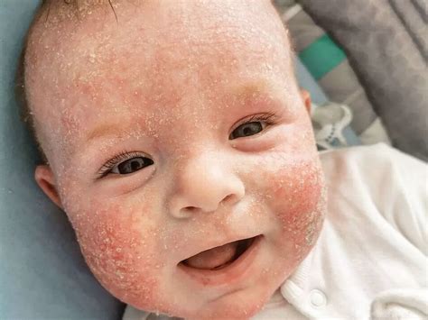 Milk Allergy Baby Rash on Face: 72% of Infants Are Affected