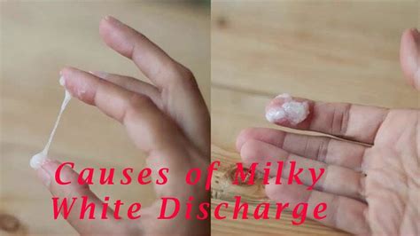 Milky White Discharge No Odor: What it Means and When to Seek Help