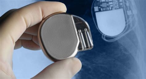 Miniaturized medical implants: