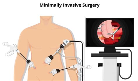 Minimally invasive surgery: