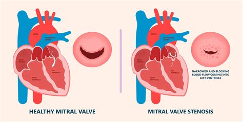 Mitral Valve Disease: