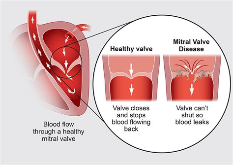 Mitral Valve Disease (MVD)