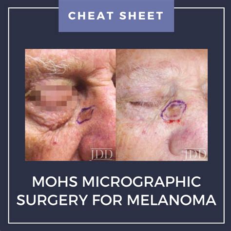 Mohs Micrographic Surgery (MMS)